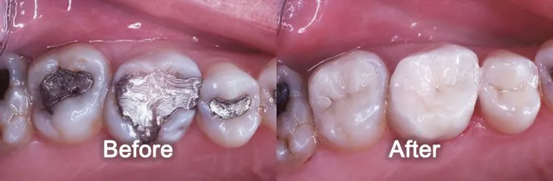 White Fillings