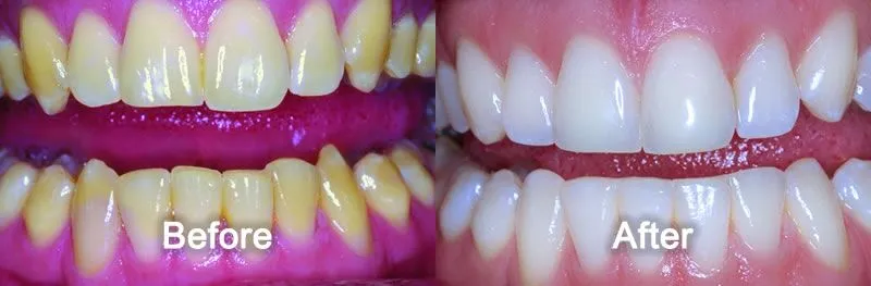 Teeth Whitening