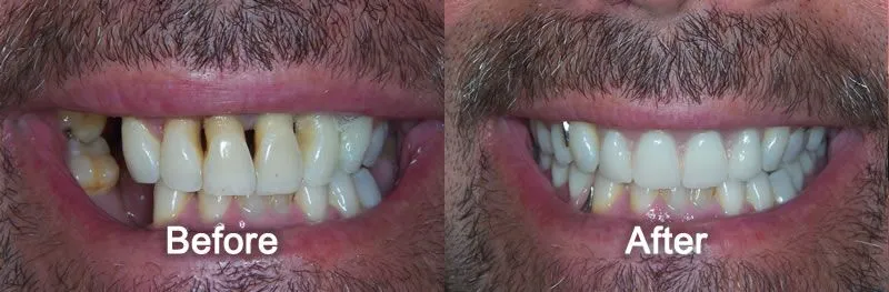 Smile Makeover
