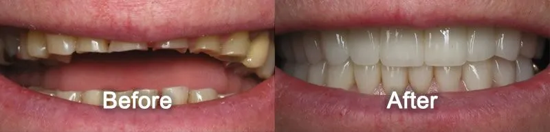Porcelain Veneers