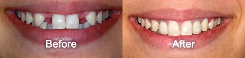 Dental Implants