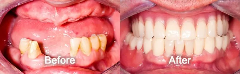 Dentures