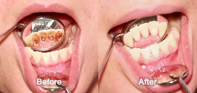 Dental Cleaning