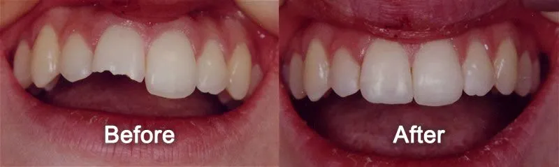 Cosmetic Bonding